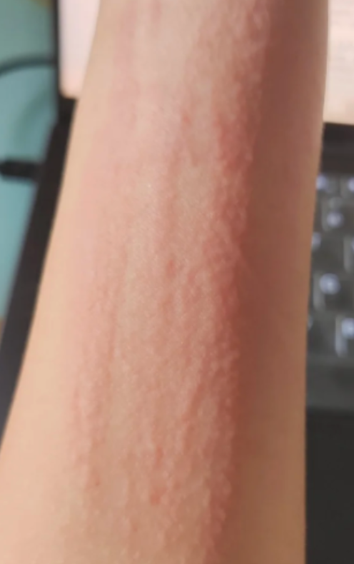 Understanding Urushi Rash (Urushiol Dermatitis): Chemistry, Myths, and Safe Studio Practices
